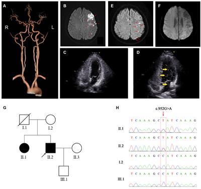 The FGG c.952G>A variant causes congenital dysfibrinogenemia characterized by recurrent cerebral infarction: a case report